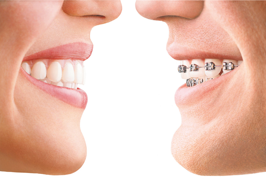 Ortodonzia tradizionale e con allineatori trasparenti