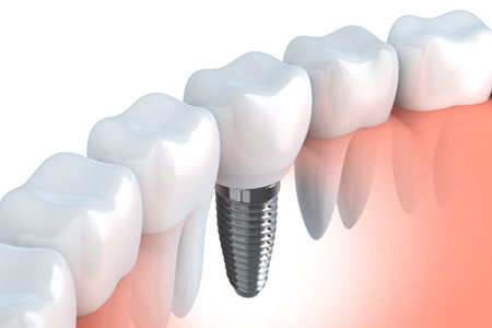 Chirurgia implantare - impianti